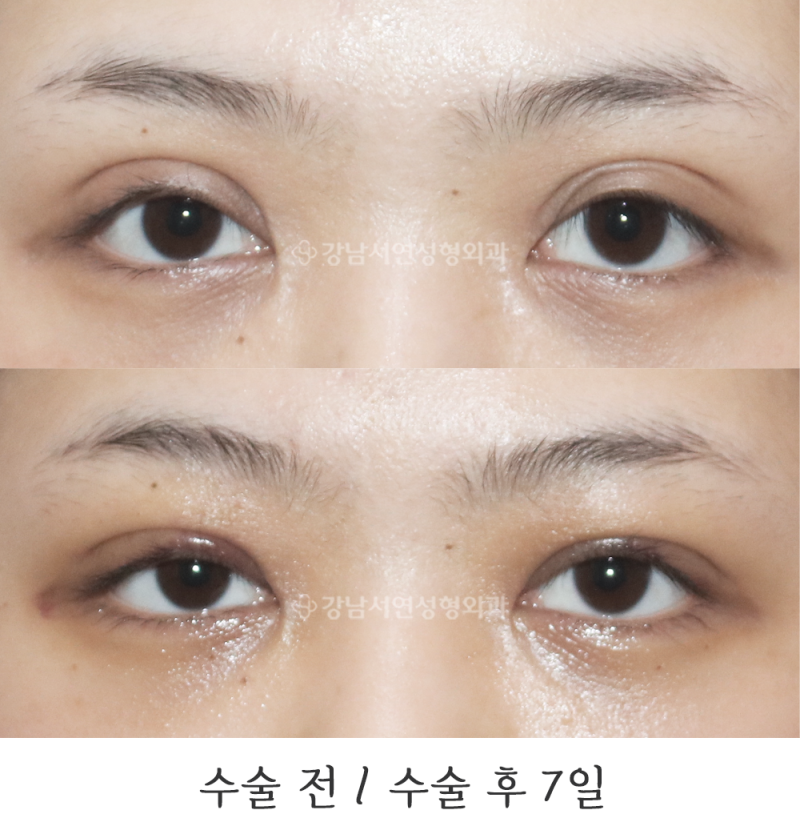 Gangnam Seoyeon Plastic Surgery: Line Lowering and Multiple Crease Correction Before & After Photos