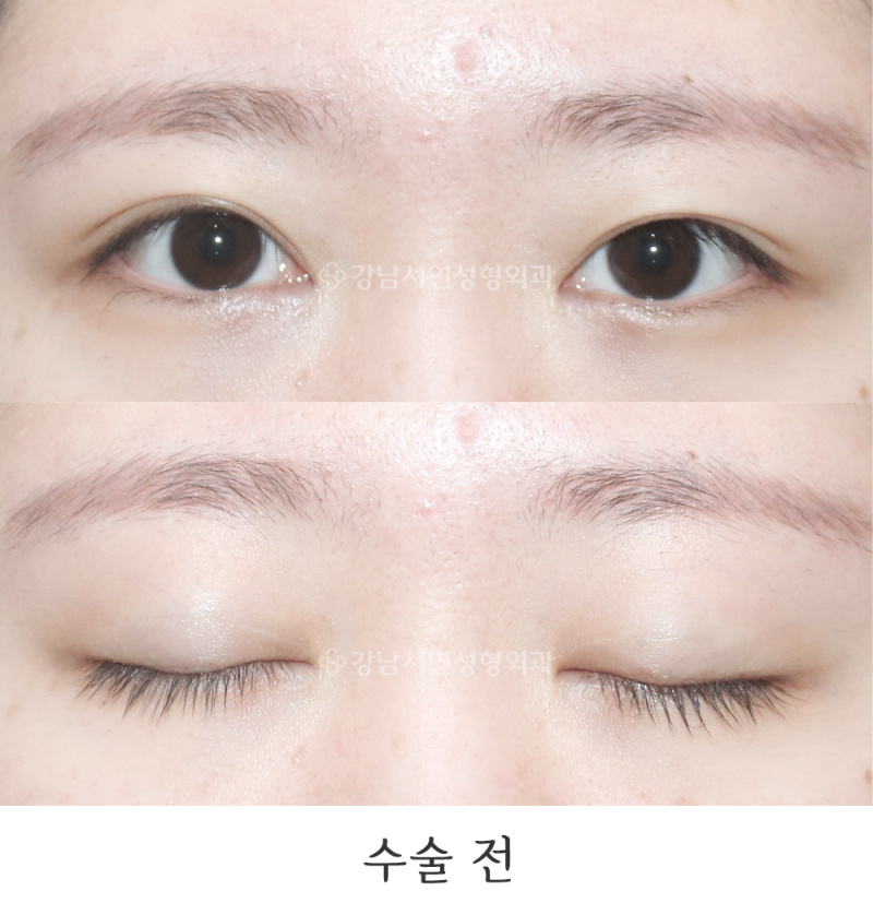 Gangnam Seoyeon Plastic Surgery Clinic: Non-incisional Double Eyelid Revision Surgery Before & After Photos
