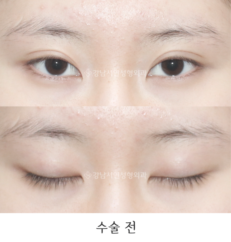 Gangnam Seoyeon Plastic Surgery: Double Line Extraction and Crease Lowering Before & After Photos