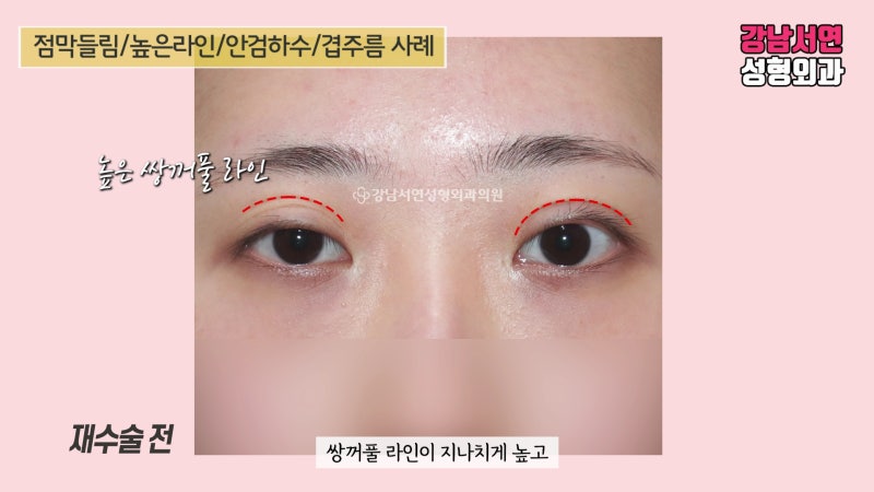 4 tháng sau phẫu thuật lại nếp mí chồng, lật niêm mạc và sụp mí