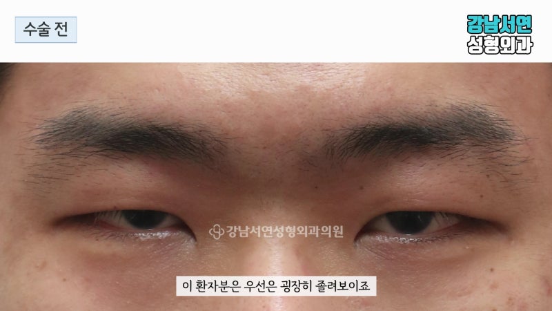 メンズ眼瞼下垂修正、実際の症例写真で詳しく解説