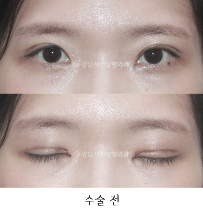 Ảnh trước và sau khi chỉnh sửa sớm tình trạng chỉnh sửa quá mức (cải thiện cảm giác căng mắt) tại Viện thẩm mỹ Gangnam Seoyeon