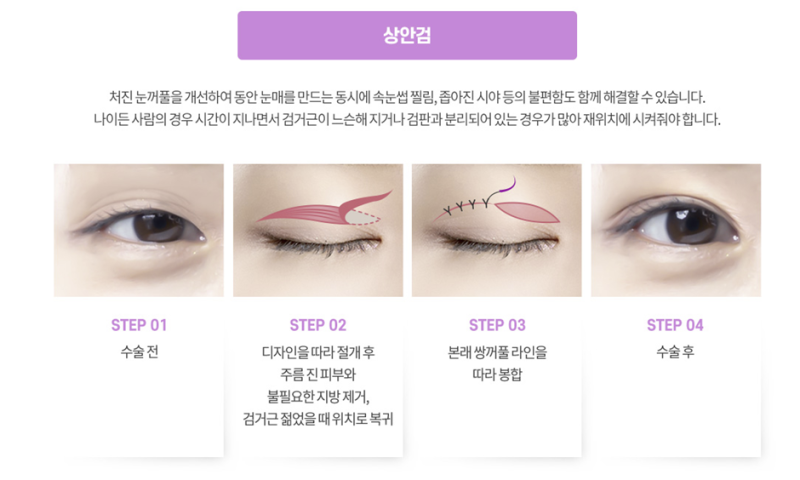 처진 눈꺼풀 끌어올려↗↗↗  상안검 수술하세요~