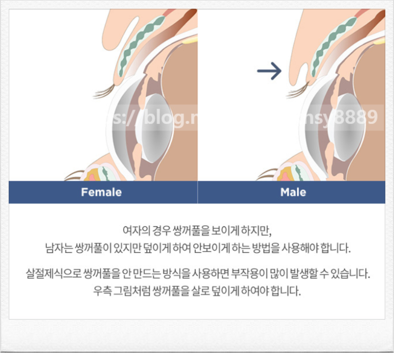 Phẫu thuật ẩn mí mắt kép: từ ấn tượng đậm đến ánh mắt thanh thoát