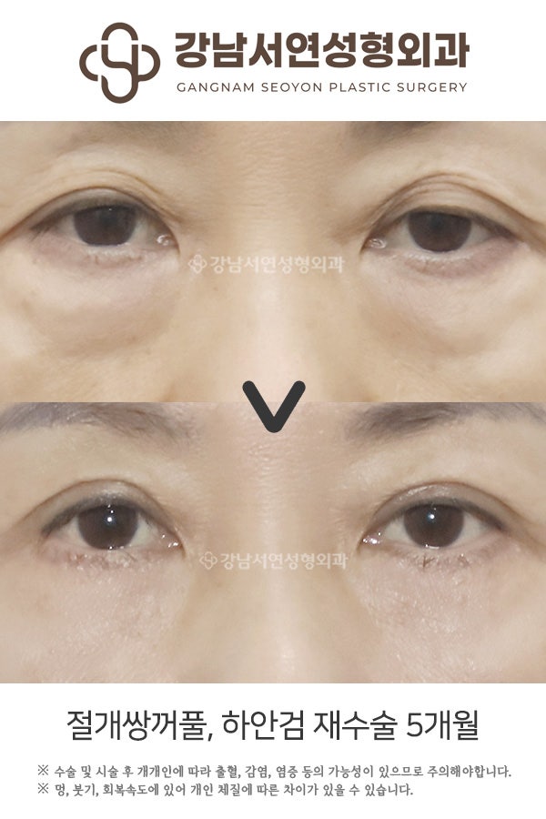 하안검, 눈밑지방재배치술 차이 _ 눈밑 처짐과 다크서클의 차이 사진 4