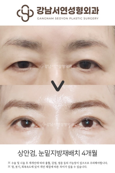 중년눈성형 상안검, 하안검 동시 진행해도 될까? 사진 4
