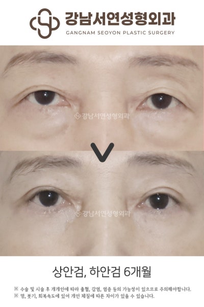 중년눈성형 상안검, 하안검 동시 진행해도 될까? 사진 2
