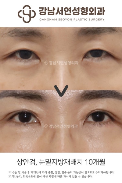 중년눈성형 상안검, 하안검 동시 진행해도 될까? 사진 3