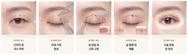 쌍꺼풀수술 매몰법 vs 절개법 차이, 첫 눈성형이라면 꼭 알아야 할 기준 사진 4