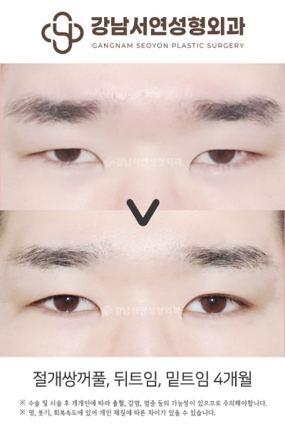 쌍꺼풀수술 매몰법 vs 절개법 차이, 첫 눈성형이라면 꼭 알아야 할 기준 사진 10
