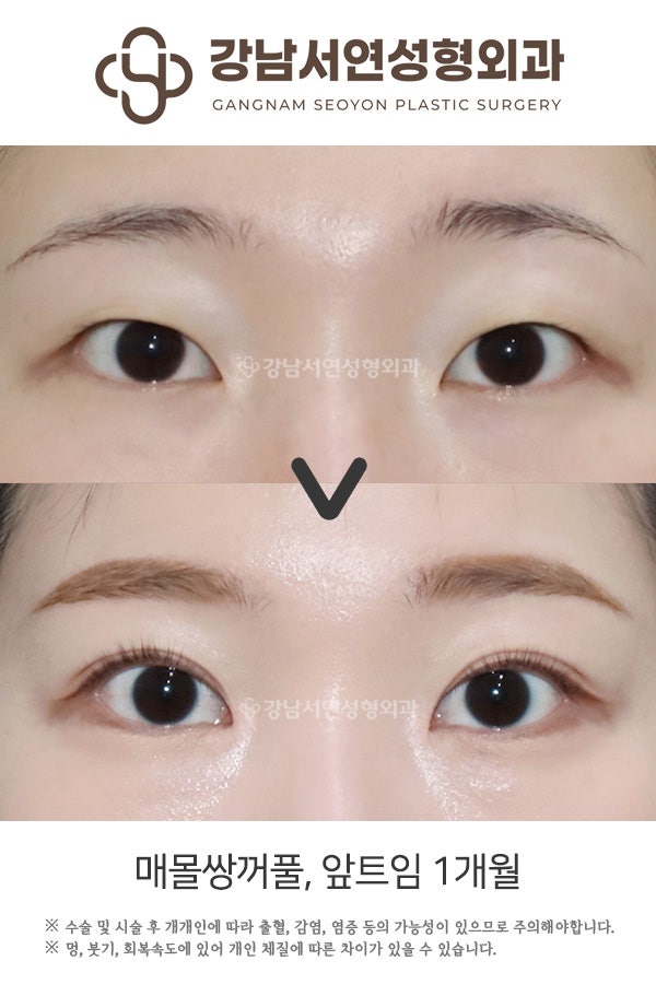 쌍꺼풀수술 매몰법 vs 절개법 차이, 첫 눈성형이라면 꼭 알아야 할 기준 사진 3