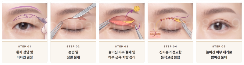 쌍꺼풀수술 매몰법 vs 절개법 차이, 첫 눈성형이라면 꼭 알아야 할 기준 사진 6