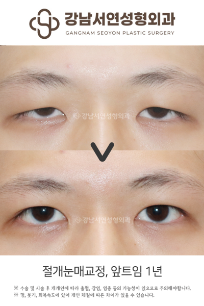 쌍꺼풀수술 vs 눈매교정, 나에게 맞는 건? 첫 눈성형 전 헷갈리는 수술 구분법 사진 6