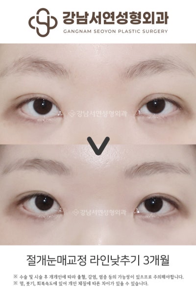 쌍꺼풀수술 vs 눈매교정, 나에게 맞는 건? 첫 눈성형 전 헷갈리는 수술 구분법 사진 5