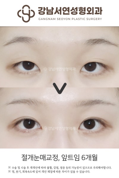 쌍꺼풀수술 vs 눈매교정, 나에게 맞는 건? 첫 눈성형 전 헷갈리는 수술 구분법 사진 7