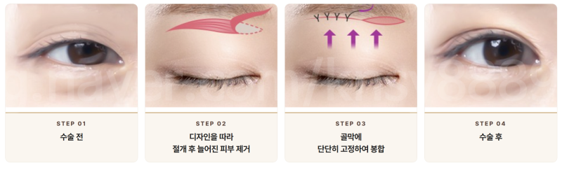 눈썹하거상 흉터, 어디에 생기고 얼마나 눈에 띄나요? 사진 2