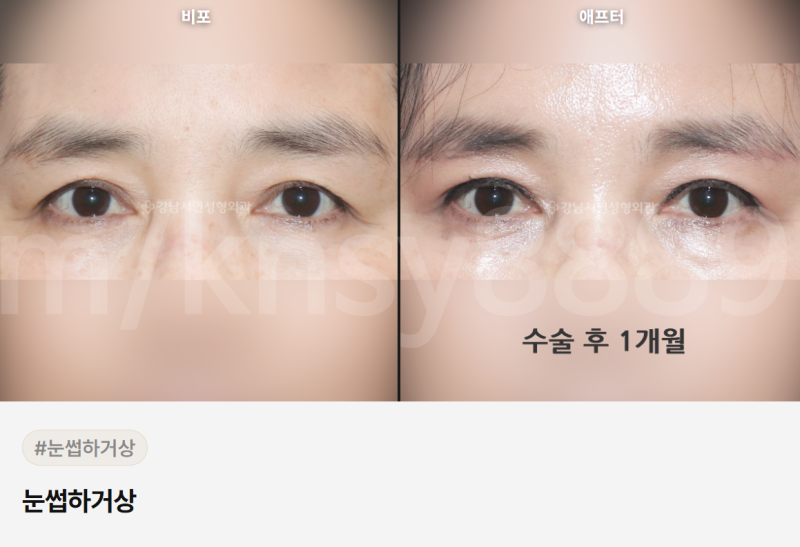 눈썹하거상 흉터, 어디에 생기고 얼마나 눈에 띄나요? 사진 3