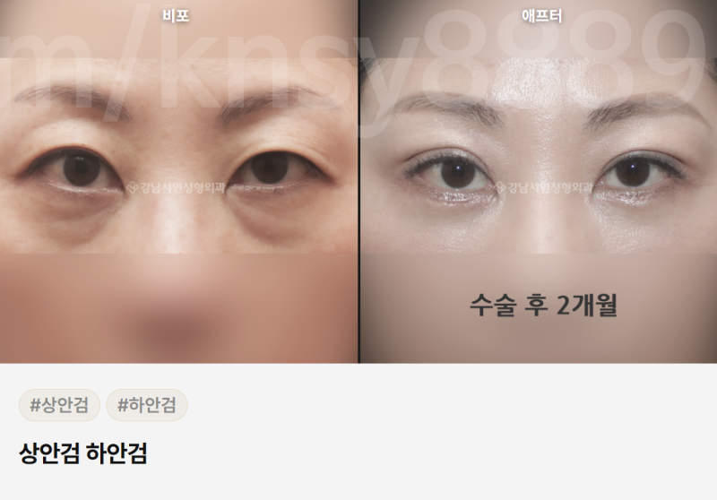 하안검 회복기간, 수술 방법별로 다릅니다 — 단계별 완전 정리 사진 5