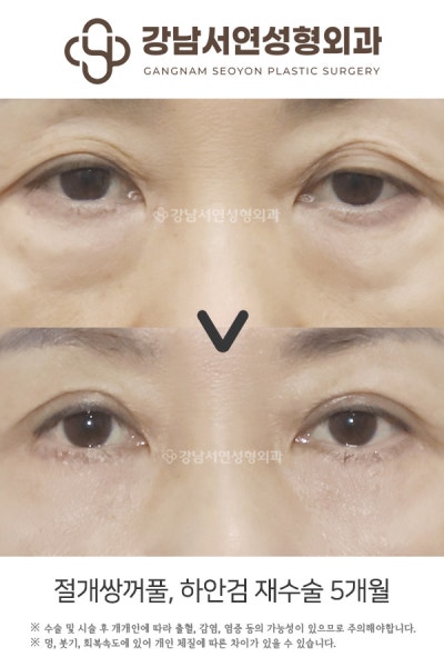 하안검 회복기간, 수술 방법별로 다릅니다 — 단계별 완전 정리