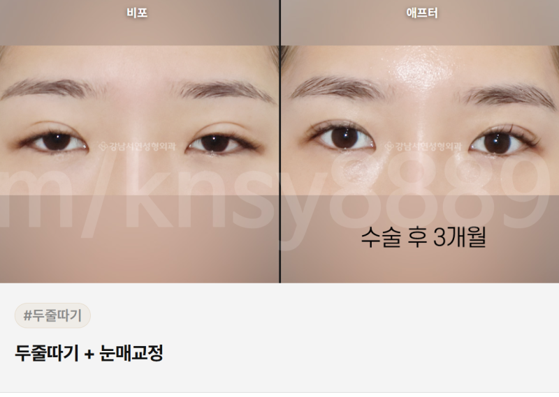 절개 눈매교정술 풀림, 왜 생기고 어떻게 대처해야 하나요? 사진 4