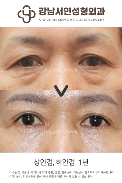 중년 눈성형 잘하는곳, 어떻게 골라야 할까요? 사진 2