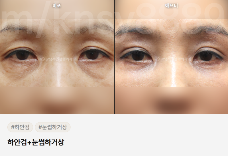 중년 눈성형 잘하는곳, 어떻게 골라야 할까요? 사진 4