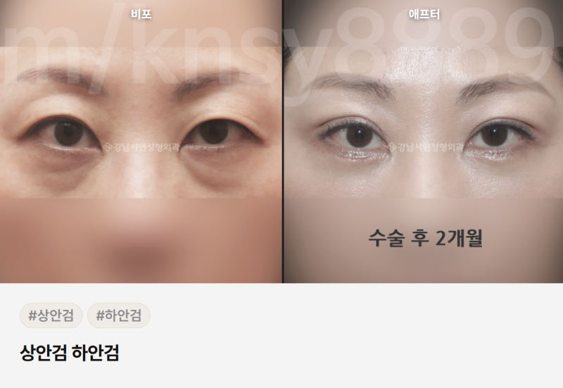 중년 눈성형 잘하는곳, 어떻게 골라야 할까요? 사진 7