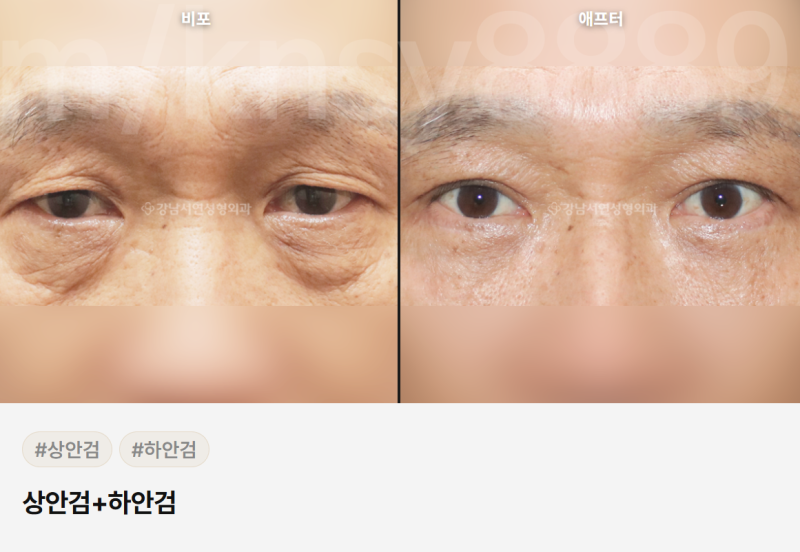 중년 눈성형 잘하는곳, 어떻게 골라야 할까요? 사진 5