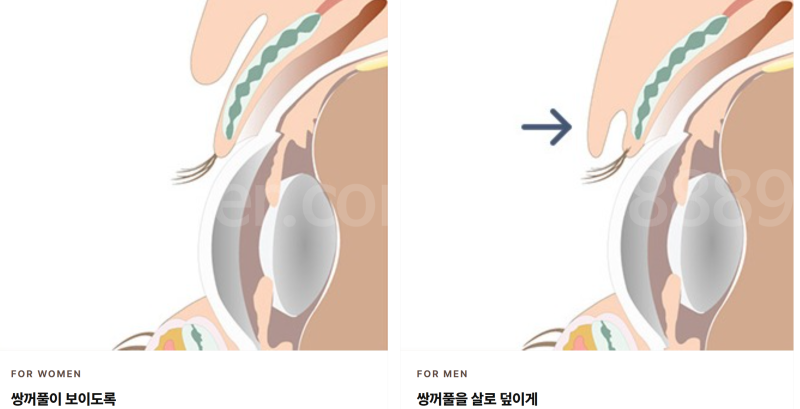 남자 쌍꺼풀 절개, 티 안 나게 자연스럽게 될 수 있을까요?
