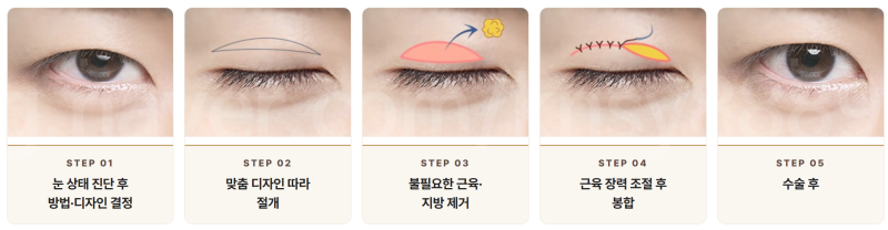 남자 쌍꺼풀 절개, 티 안 나게 자연스럽게 될 수 있을까요? 사진 4