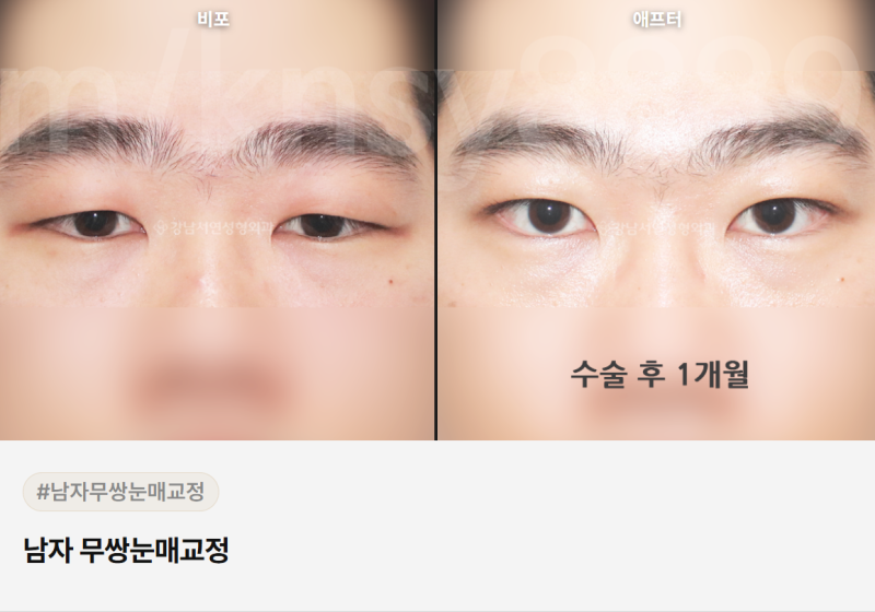남자 쌍꺼풀 절개, 티 안 나게 자연스럽게 될 수 있을까요? 사진 11