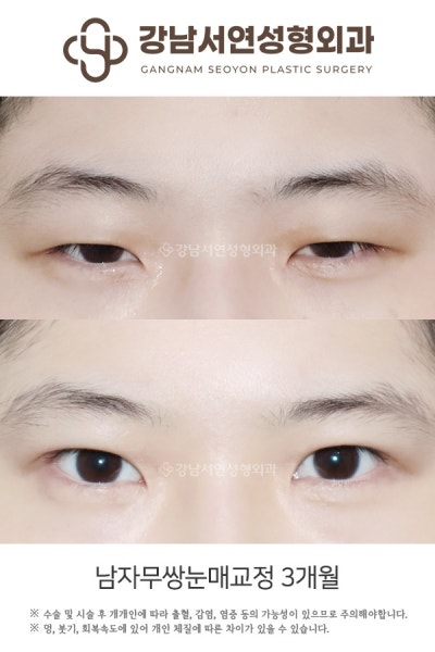 남자 쌍꺼풀 절개, 티 안 나게 자연스럽게 될 수 있을까요?