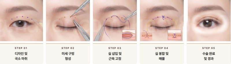 남자 쌍꺼풀 절개, 티 안 나게 자연스럽게 될 수 있을까요? 사진 3