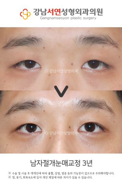 남자 쌍꺼풀 절개, 티 안 나게 자연스럽게 될 수 있을까요? 사진 10