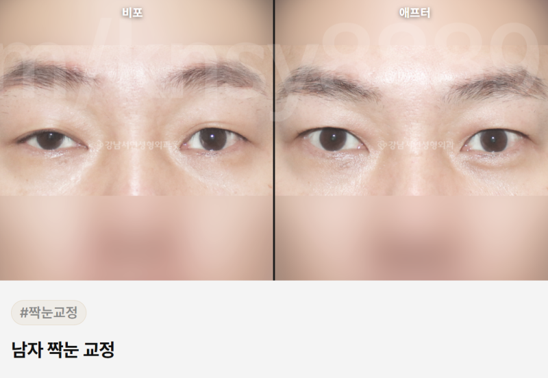 남자 쌍꺼풀 절개, 티 안 나게 자연스럽게 될 수 있을까요? 사진 8