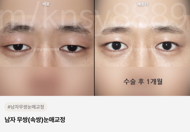 남자 쌍수 병원, 어떤 기준으로 골라야 할까요? 사진 5