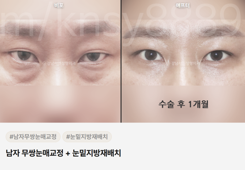남자 쌍수 병원, 어떤 기준으로 골라야 할까요? 사진 6