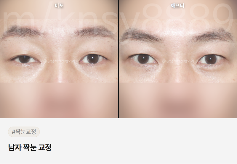 남자 쌍수 병원, 어떤 기준으로 골라야 할까요? 사진 4