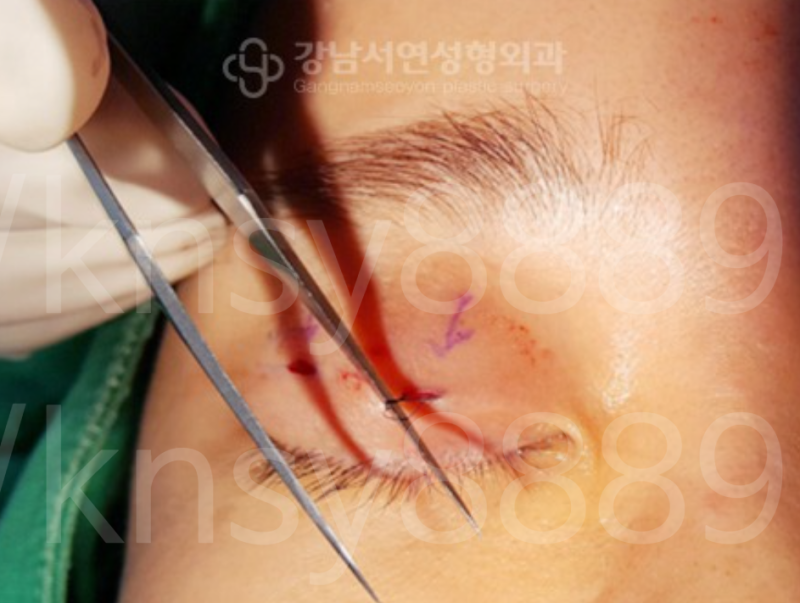 매몰법 푸는 방법, 절개 없이도 가능합니다 — 미세 구멍으로 실을 꺼내는 방식