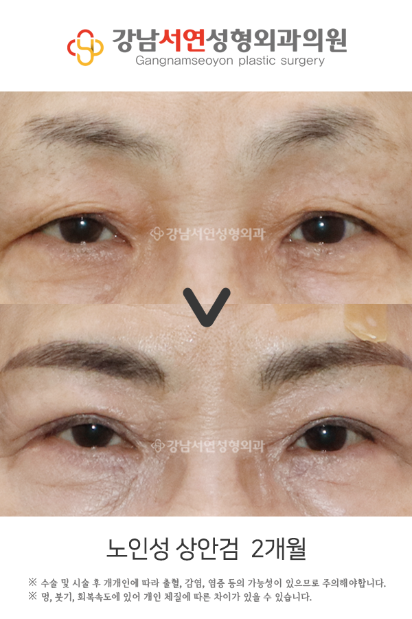 눈꺼풀 주름 개선, 원인이 다르면 치료법도 달라집니다 사진 3