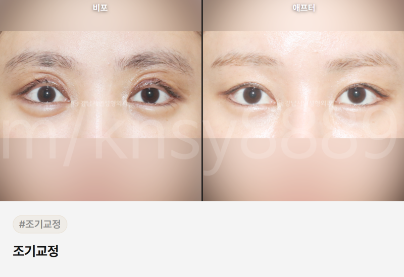 눈꺼풀 주름 개선, 원인이 다르면 치료법도 달라집니다 사진 8
