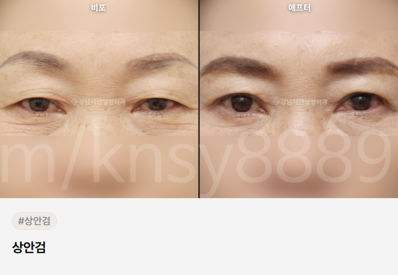 눈꺼풀 주름 개선, 원인이 다르면 치료법도 달라집니다