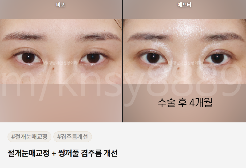눈꺼풀 주름 개선, 원인이 다르면 치료법도 달라집니다 사진 7