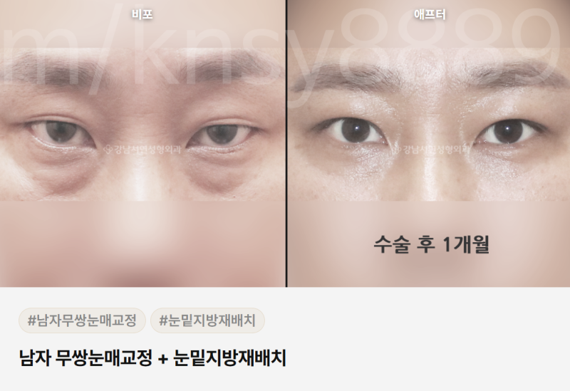 하안검 뜻, 정확히 무엇인지 알기 쉽게 정리했습니다 사진 10
