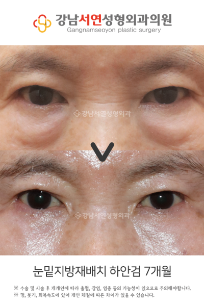 하안검 뜻, 정확히 무엇인지 알기 쉽게 정리했습니다 사진 3