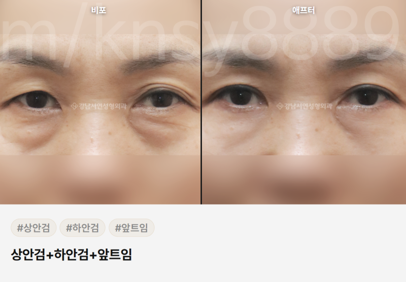 하안검 뜻, 정확히 무엇인지 알기 쉽게 정리했습니다 사진 8