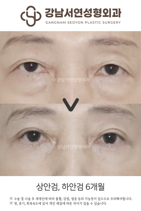 하안검 뜻, 정확히 무엇인지 알기 쉽게 정리했습니다 사진 9