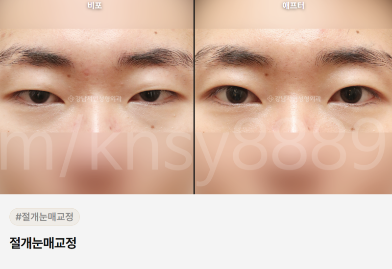 무쌍 눈매교정술, 쌍꺼풀 없이 눈매를 또렷하게 만들 수 있나요? 사진 13
