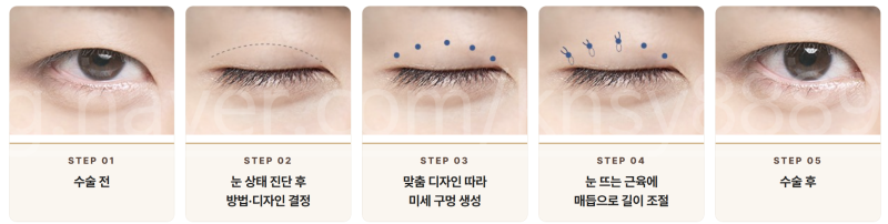 무쌍 눈매교정술, 쌍꺼풀 없이 눈매를 또렷하게 만들 수 있나요? 사진 9