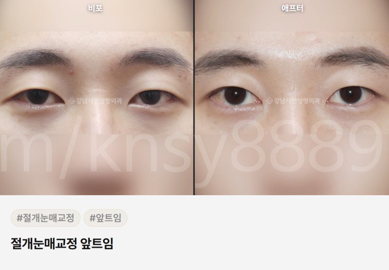 무쌍 눈매교정술, 쌍꺼풀 없이 눈매를 또렷하게 만들 수 있나요? 사진 14